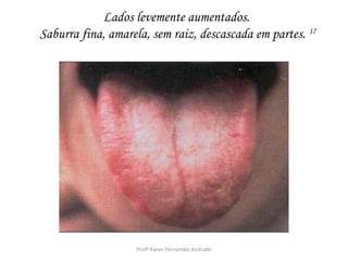 Lados levemente aumentados.
Saburra fina, amarela, sem raiz, descascada em partes. 17




                   Profª Karen Fernandes Andrade
 