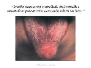 Vermelho-escura a roxo-avermelhada. Mais vermelha e
aumentada na parte anterior. Descascada; saburra nos lados. 19




                       Profª Karen Fernandes Andrade
 