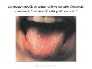 Levemente vermelha ao centro. Saburra sem raiz; descascada;
    aumentada; fina e amarela entre ponta e centro. 20




                     Profª Karen Fernandes Andrade
 
