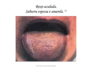 Roxo-azulada.
Saburra espessa e amarela. 22




       Profª Karen Fernandes Andrade
 