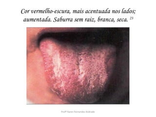 Cor vermelho-escura, mais acentuada nos lados;
 aumentada. Saburra sem raiz, branca, seca. 23




                Profª Karen Fernandes Andrade
 