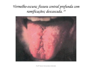 Vermelho-escura; fissura central profunda com
        ramificações; descascada. 24




               Profª Karen Fernandes Andrade
 