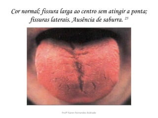 Cor normal; fissura larga ao centro sem atingir a ponta;
       fissuras laterais. Ausência de saburra. 25




                     Profª Karen Fernandes Andrade
 