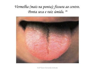 Vermelha (mais na ponta); fissura ao centro.
        Ponta seca e raiz úmida. 26




               Profª Karen Fernandes Andrade
 