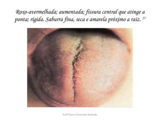 Roxo-avermelhada; aumentada; fissura central que atinge a
ponta; rígida. Saburra fina, seca e amarela próximo a raiz. 27




                      Profª Karen Fernandes Andrade
 