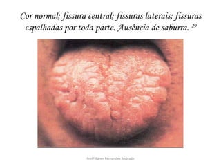 Cor normal; fissura central; fissuras laterais; fissuras
 espalhadas por toda parte. Ausência de saburra. 29




                    Profª Karen Fernandes Andrade
 