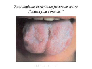 Roxo-azulada; aumentada; fissura ao centro.
         Saburra fina e branca. 30




              Profª Karen Fernandes Andrade
 