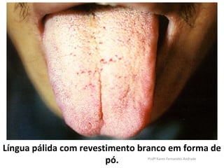 Língua pálida com revestimento branco em forma de
                        pó.     Profª Karen Fernandes Andrade
 