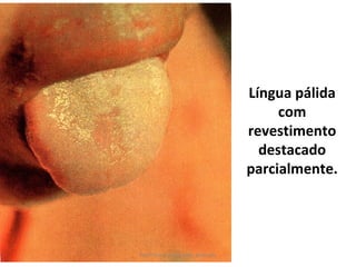 Língua pálida
                                     com
                                revestimento
                                  destacado
                                parcialmente.




Profª Karen Fernandes Andrade
 