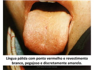 Língua pálida com ponto vermelho e revestimento
    branco, pegajoso e discretamente amarelo.
                 Profª Karen Fernandes Andrade
 