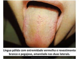 Língua pálida com extremidade vermelha e revestimento
    branco e pegajoso, amarelado nas duas laterais.
                    Profª Karen Fernandes Andrade
 