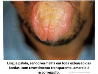 Língua pálida, sendo vermelha em toda extensão das
 bordas, com revestimento transparente, amarelo e
                   escorregadio.     Profª Karen Fernandes Andrade
 