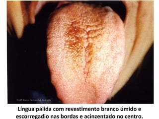 Profª Karen Fernandes Andrade


 Língua pálida com revestimento branco úmido e
escorregadio nas bordas e acinzentado no centro.
 