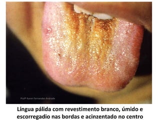 Profª Karen Fernandes Andrade



Língua pálida com revestimento branco, úmido e
escorregadio nas bordas e acinzentado no centro
 