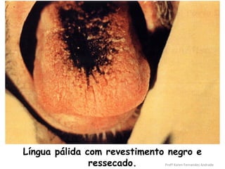 Língua pálida com revestimento negro e
               ressecado.     Profª Karen Fernandes Andrade
 