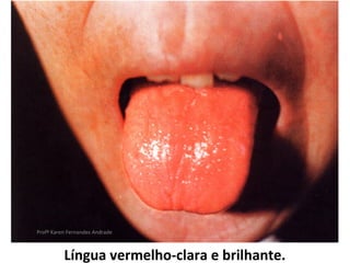 Profª Karen Fernandes Andrade



          Língua vermelho-clara e brilhante.
 