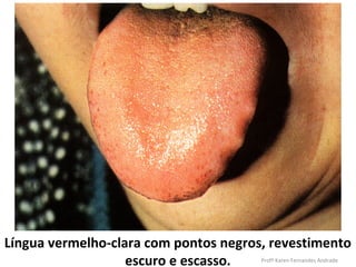 Língua vermelho-clara com pontos negros, revestimento
                   escuro e escasso.   Profª Karen Fernandes Andrade
 