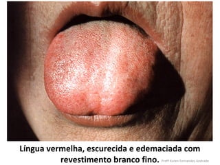 Língua vermelha, escurecida e edemaciada com
          revestimento branco fino.
                                  Profª Karen Fernandes Andrade
 