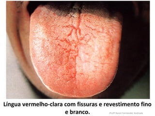 Língua vermelho-clara com fissuras e revestimento fino
                      e branco.       Profª Karen Fernandes Andrade
 