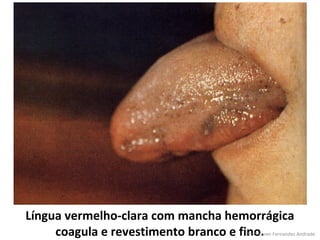 Língua vermelho-clara com mancha hemorrágica
     coagula e revestimento branco e fino.
                                    Profª Karen Fernandes Andrade
 