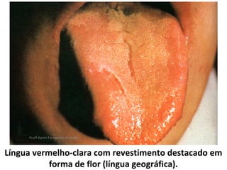 Profª Karen Fernandes Andrade



Língua vermelho-clara com revestimento destacado em
           forma de flor (língua geográfica).
 