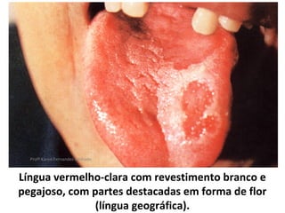 Profª Karen Fernandes Andrade



Língua vermelho-clara com revestimento branco e
pegajoso, com partes destacadas em forma de flor
               (língua geográfica).
 