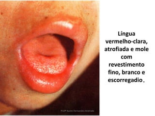 Língua
                                vermelho-clara,
                                atrofiada e mole
                                       com
                                 revestimento
                                 fino, branco e
                                 escorregadio.



Profª Karen Fernandes Andrade
 