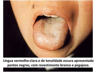 Língua vermelho-clara e de tonalidade escura apresentado
   pontos negros, com revestimento branco e pegajoso.
                     Profª Karen Fernandes Andrade
 