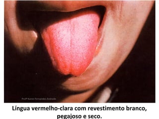 Profª Karen Fernandes Andrade



Língua vermelho-clara com revestimento branco,
               pegajoso e seco.
 