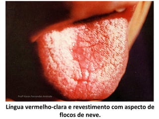 Profª Karen Fernandes Andrade



Língua vermelho-clara e revestimento com aspecto de
                   flocos de neve.
 