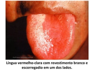 Profª Karen Fernandes Andrade


Língua vermelho-clara com revestimento branco e
         escorregadio em um dos lados.
 