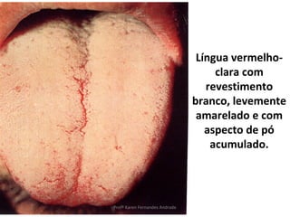 Língua vermelho-
                                     clara com
                                   revestimento
                                branco, levemente
                                 amarelado e com
                                   aspecto de pó
                                    acumulado.




Profª Karen Fernandes Andrade
 