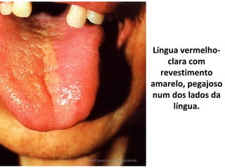 Língua vermelho-
                                    clara com
                                  revestimento
                                amarelo, pegajoso
                                num dos lados da
                                      língua.




Profª Karen Fernandes Andrade
 