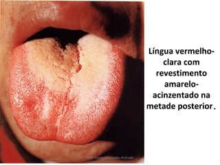 Língua vermelho-
                                    clara com
                                  revestimento
                                    amarelo-
                                 acinzentado na
                                metade posterior.




Profª Karen Fernandes Andrade
 
