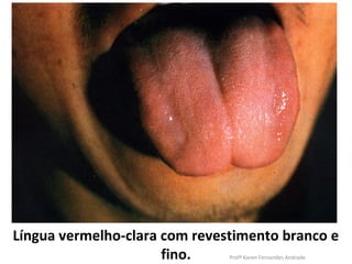 Língua vermelho-clara com revestimento branco e
                      fino.    Profª Karen Fernandes Andrade
 
