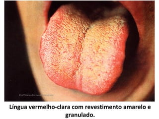 Profª Karen Fernandes Andrade



Língua vermelho-clara com revestimento amarelo e
                   granulado.
 