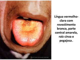 Língua vermelho-
                                    clara com
                                  revestimento
                                  branco, parte
                                 central amarela,
                                   raiz cinza e
                                    pegajosa.



Profª Karen Fernandes Andrade
 