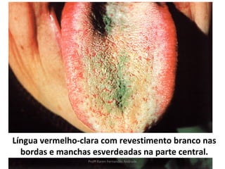 Língua vermelho-clara com revestimento branco nas
  bordas e manchas esverdeadas na parte central.
                  Profª Karen Fernandes Andrade
 