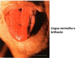 Língua vermelha e
                                brilhante




Profª Karen Fernandes Andrade
 