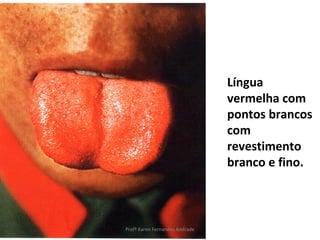 Língua
                                vermelha com
                                pontos brancos
                                com
                                revestimento
                                branco e fino.



Profª Karen Fernandes Andrade
 