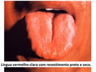 Língua vermelho-clara com revestimento preto e seco.
                     Profª Karen Fernandes Andrade
 
