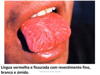 Língua vermelha e fissurada com revestimento fino,
branco e úmido.      Profª Karen Fernandes Andrade
 