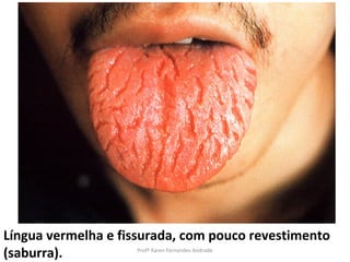 Língua vermelha e fissurada, com pouco revestimento
(saburra).          Profª Karen Fernandes Andrade
 