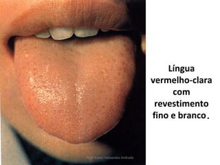 Língua
                                vermelho-clara
                                     com
                                 revestimento
                                fino e branco.



Profª Karen Fernandes Andrade
 