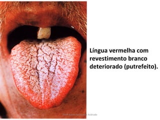 Língua vermelha com
                      revestimento branco
                      deteriorado (putrefeito).




Profª Karen Fernandes Andrade
 