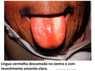 Língua vermelha descamada no centro e com
revestimento amarelo-claro.   Profª Karen Fernandes Andrade
 