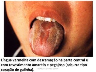 Língua vermelha com descamação na parte central e
com revestimento amarelo e pegajoso (saburra tipo
coração de galinha).Profª Karen Fernandes Andrade
 