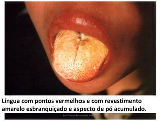 Língua com pontos vermelhos e com revestimento
amarelo esbranquiçado e aspecto de pó acumulado.
                    Profª Karen Fernandes Andrade
 
