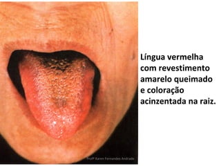 Língua vermelha
                                com revestimento
                                amarelo queimado
                                e coloração
                                acinzentada na raiz.




Profª Karen Fernandes Andrade
 