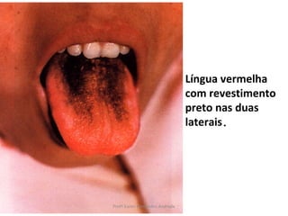 Língua vermelha
                                com revestimento
                                preto nas duas
                                laterais.




Profª Karen Fernandes Andrade
 